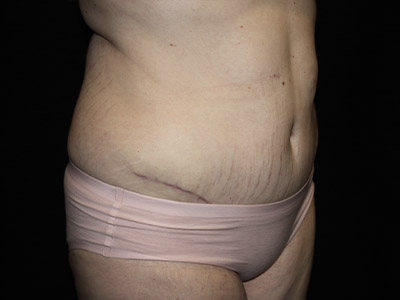 Patient #48145: Tummy Tuck After Image