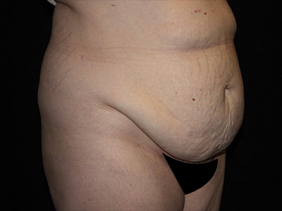 Patient #48145: Tummy Tuck Before Image