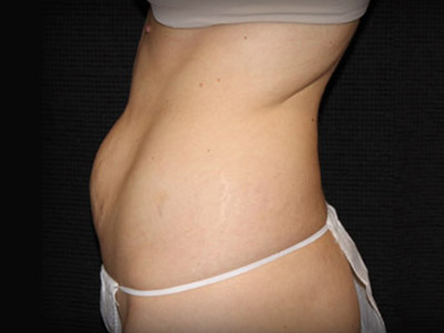 Patient #51119: Tummy Tuck Before Image