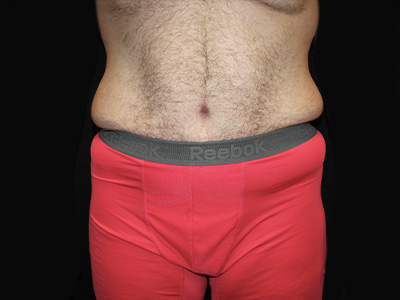 Patient #60837: Tummy Tuck After Image