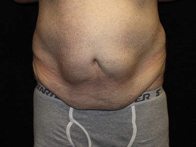 Patient #60837: Tummy Tuck Before Image