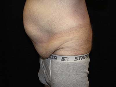 Patient #60837: Tummy Tuck Before Image