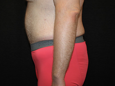 Patient #60837: Tummy Tuck After Image