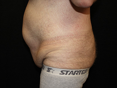 Patient #60837: Tummy Tuck Before Image