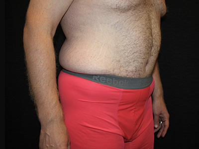 Patient #60837: Tummy Tuck After Image