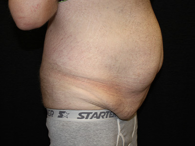 Patient #60837: Tummy Tuck Before Image
