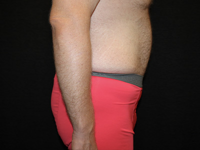 Patient #60837: Tummy Tuck After Image