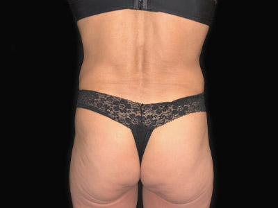 Patient #68432: Tummy Tuck with Hernia Repair After Image