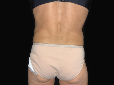 Patient #68432: Tummy Tuck with Hernia Repair Before Image