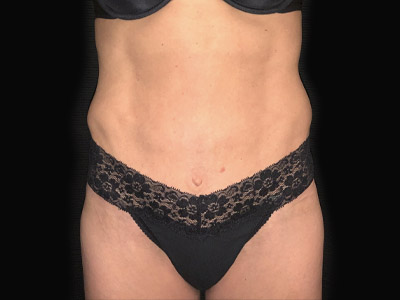 Patient #68432: Tummy Tuck with Hernia Repair After Image