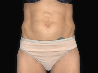 Patient #68432: Tummy Tuck with Hernia Repair Before Image