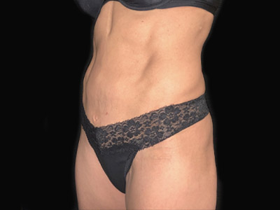 Patient #68432: Tummy Tuck with Hernia Repair After Image