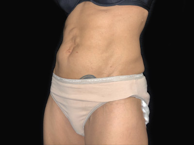 Patient #68432: Tummy Tuck with Hernia Repair Before Image