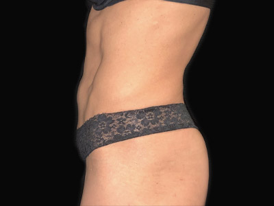 Patient #68432: Tummy Tuck with Hernia Repair After Image