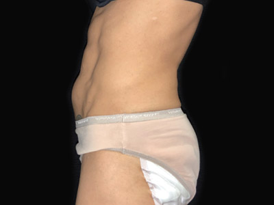 Patient #68432: Tummy Tuck with Hernia Repair Before Image