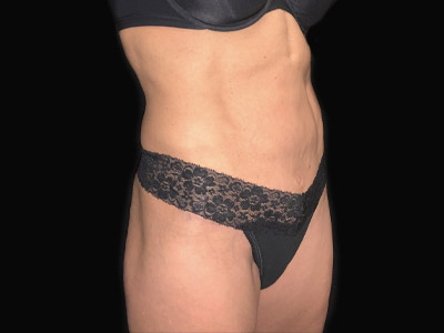 Patient #68432: Tummy Tuck with Hernia Repair After Image