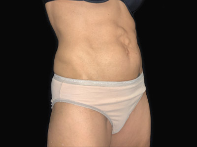 Patient #68432: Tummy Tuck with Hernia Repair Before Image