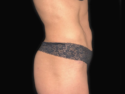 Patient #68432: Tummy Tuck with Hernia Repair After Image