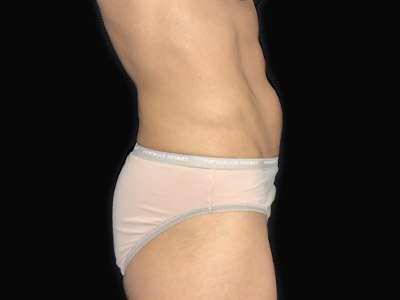 Patient #68432: Tummy Tuck with Hernia Repair Before Image
