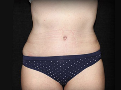 Patient #83153: Tummy Tuck After Image