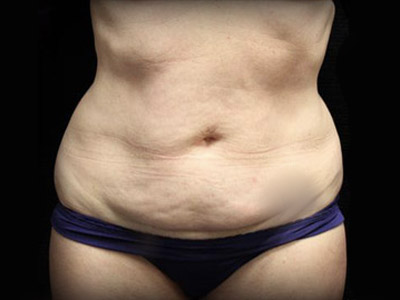 Patient #83153: Tummy Tuck Before Image