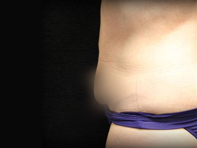 Patient #83153: Tummy Tuck Before Image