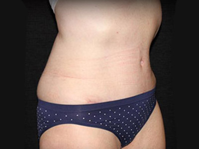 Patient #83153: Tummy Tuck After Image