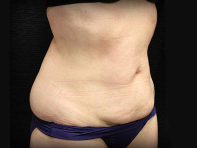 Patient #83153: Tummy Tuck Before Image