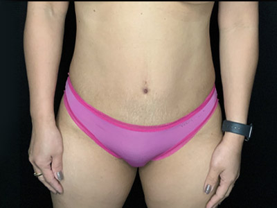 Patient #96746: Tummy Tuck with Liposuction to Flanks After Image