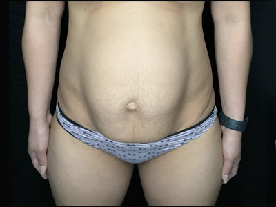 Patient #96746: Tummy Tuck with Liposuction to Flanks Before Image