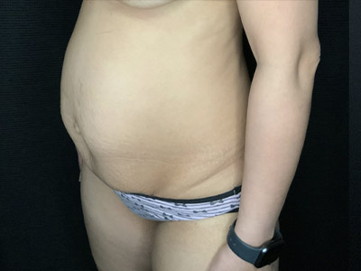 Patient #96746: Tummy Tuck with Liposuction to Flanks Before Image