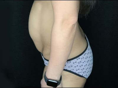 Patient #96746: Tummy Tuck with Liposuction to Flanks Before Image