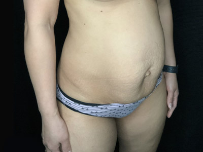 Patient #96746: Tummy Tuck with Liposuction to Flanks Before Image