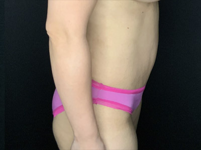 Patient #96746: Tummy Tuck with Liposuction to Flanks After Image