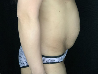 Patient #96746: Tummy Tuck with Liposuction to Flanks Before Image