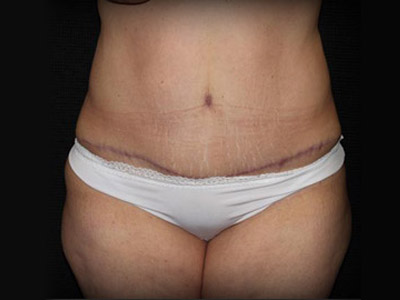 Patient #98196: Tummy Tuck After Image