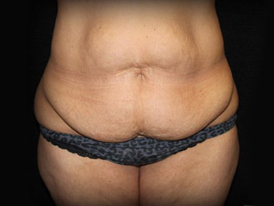 Patient #98196: Tummy Tuck Before Image