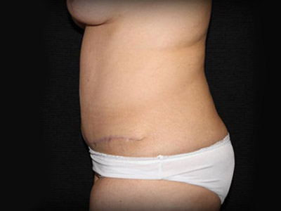 Patient #98196: Tummy Tuck After Image