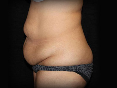 Patient #98196: Tummy Tuck Before Image