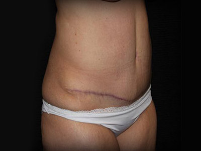 Patient #98196: Tummy Tuck After Image