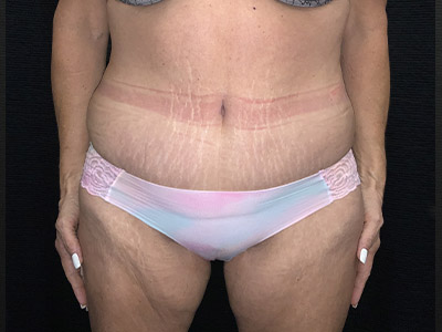 Patient #99899: Tummy Tuck After Image