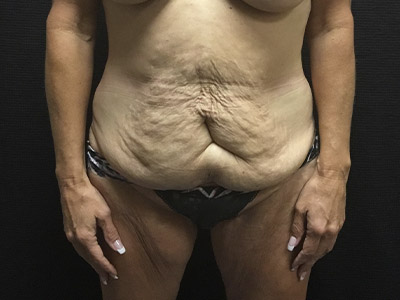 Patient #99899: Tummy Tuck Before Image