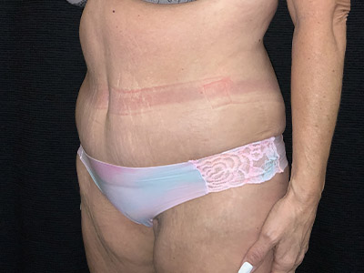 Patient #99899: Tummy Tuck After Image