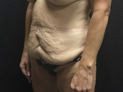 Patient #99899: Tummy Tuck Before Image