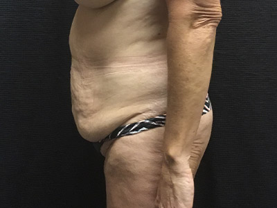 Patient #99899: Tummy Tuck Before Image