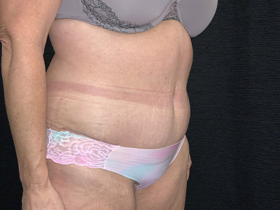 Patient #99899: Tummy Tuck After Image