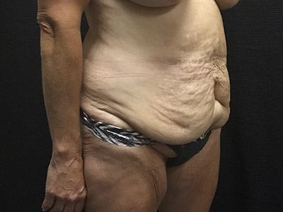 Patient #99899: Tummy Tuck Before Image