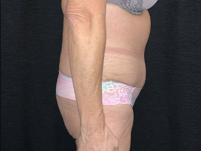 Patient #99899: Tummy Tuck After Image