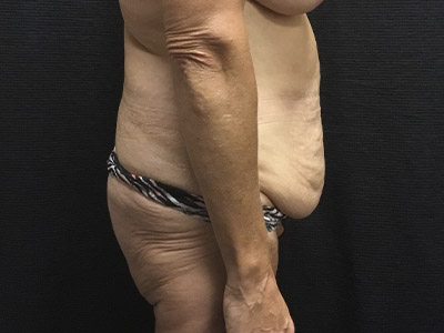 Patient #99899: Tummy Tuck Before Image