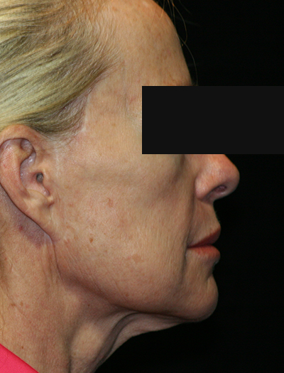 Patient #12663: Facelift & Neck Lift Before Image
